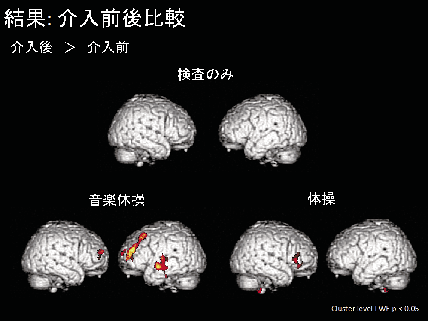 図1　介入後の脳容積の変化